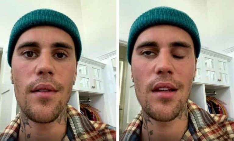 How Is Justin Bieber’s Face Paralyzed?